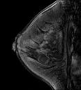 breast img